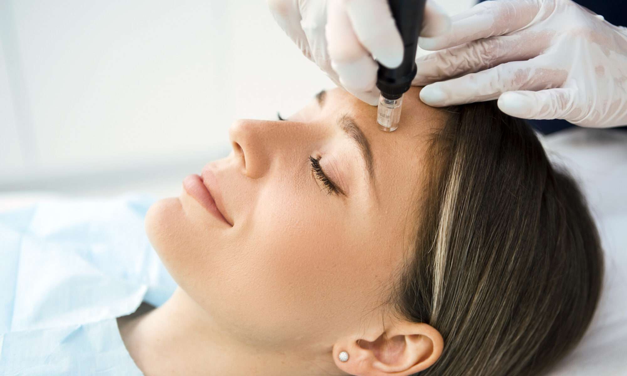 Microneedling Behandlung Düsseldorf