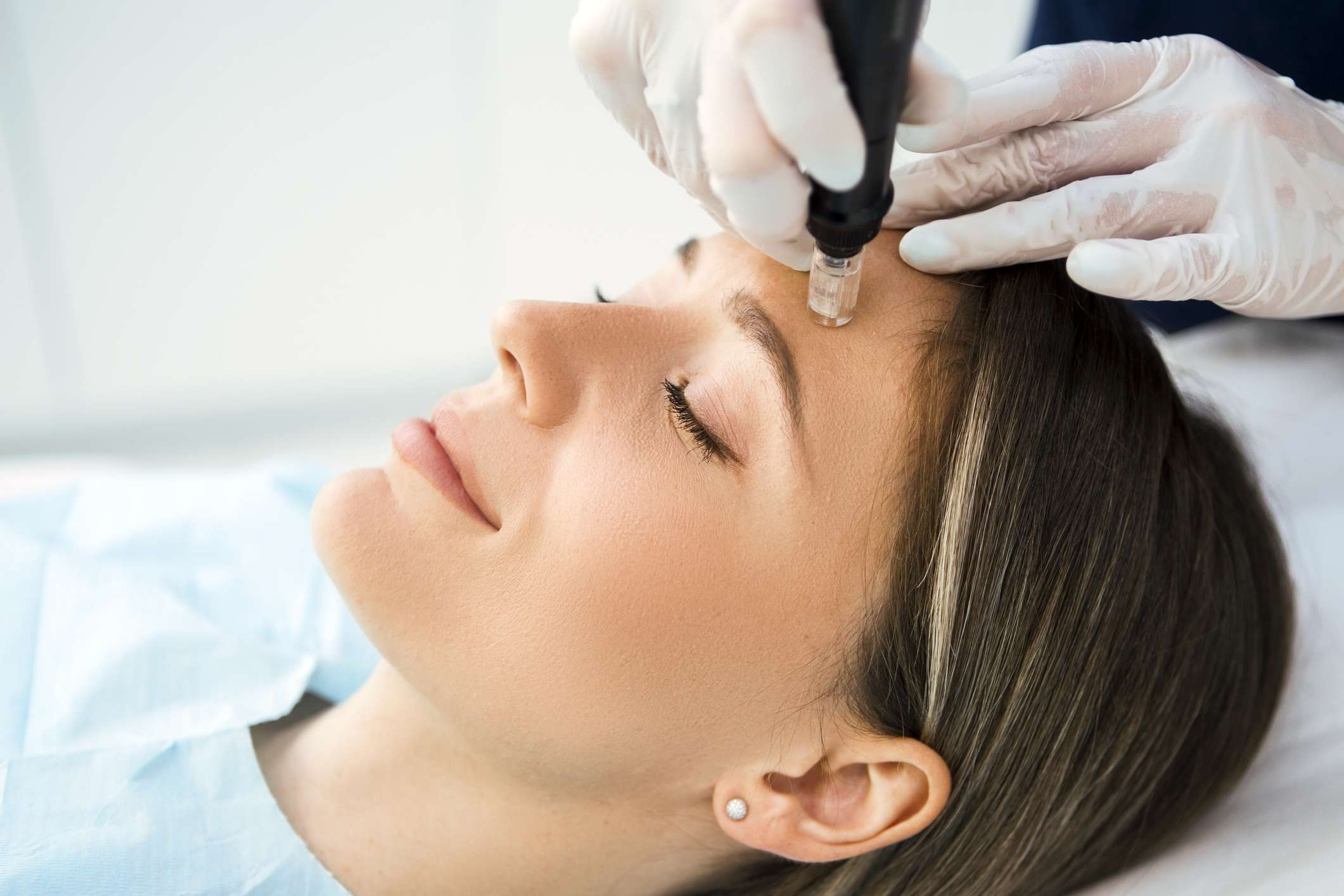 Microneedling Behandlung Düsseldorf