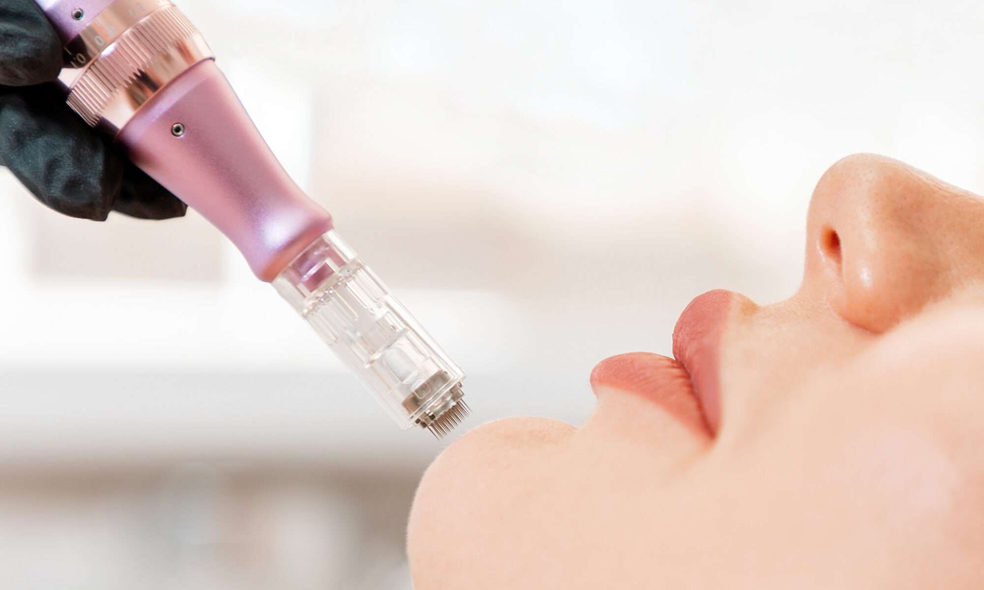 Microneedling Düsseldorf