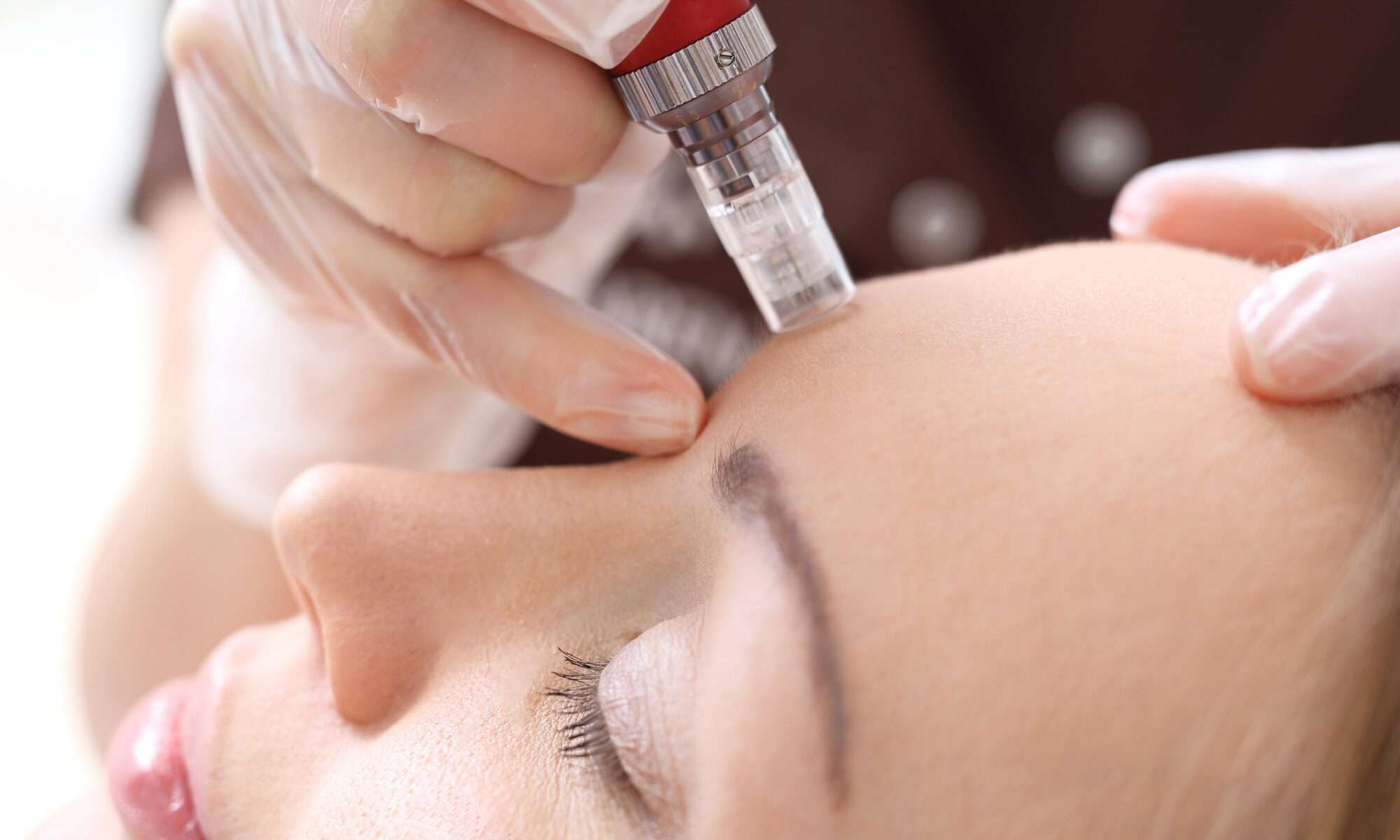 Microneedling für feinere Poren und Falten